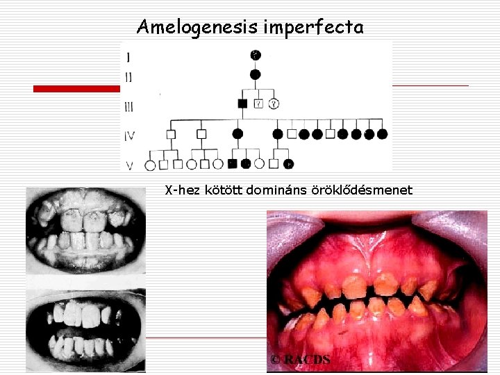 Amelogenesis imperfecta X-hez kötött domináns öröklődésmenet 