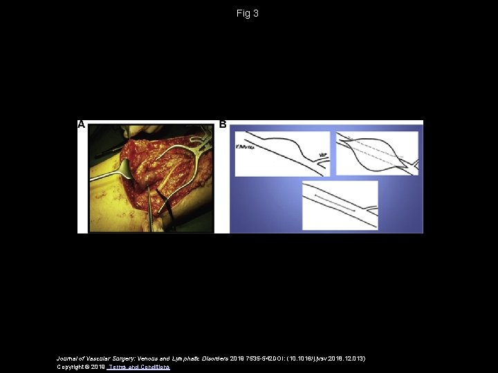 Fig 3 Journal of Vascular Surgery: Venous and Lymphatic Disorders 2019 7535 -542 DOI: