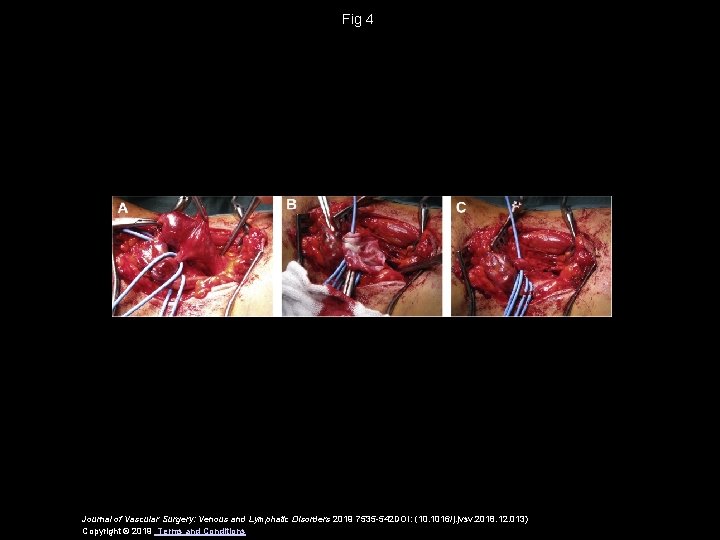 Fig 4 Journal of Vascular Surgery: Venous and Lymphatic Disorders 2019 7535 -542 DOI: