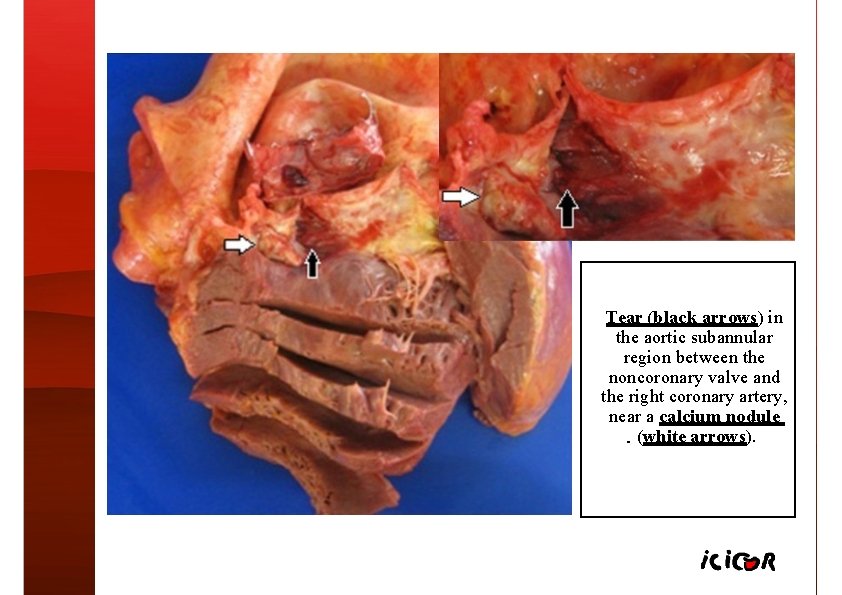 Tear (black arrows) in the aortic subannular region between the noncoronary valve and the