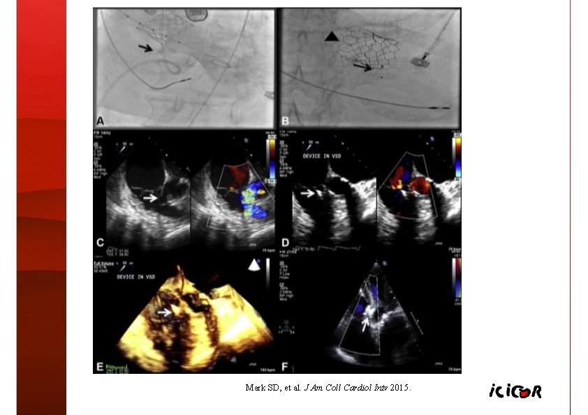 Mark SD, et al. J Am Coll Cardiol Intv 2015. 