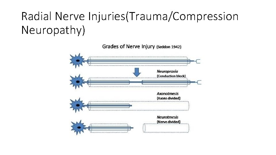 Radial Nerve Injuries(Trauma/Compression Neuropathy) 