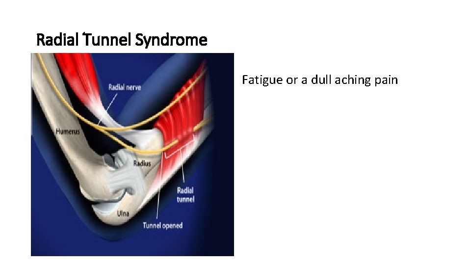 Radial Tunnel Syndrome Fatigue or a dull aching pain 