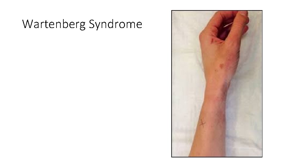 Wartenberg Syndrome 