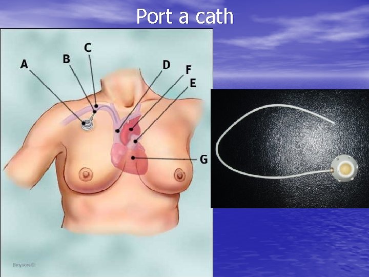 Port a cath Port a cath