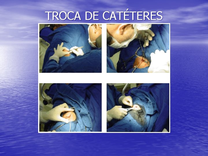 TROCA DE CATÉTERES TROCA DE CATÉTERES