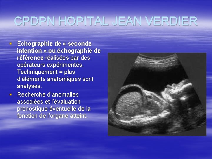 CPDPN HOPITAL JEAN VERDIER § Echographie de « seconde intention » ou échographie de