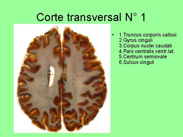 Corte transversal N° 1 • 1. Truncus corporis callosi 2. Gyrus cinguli 3. Corpus