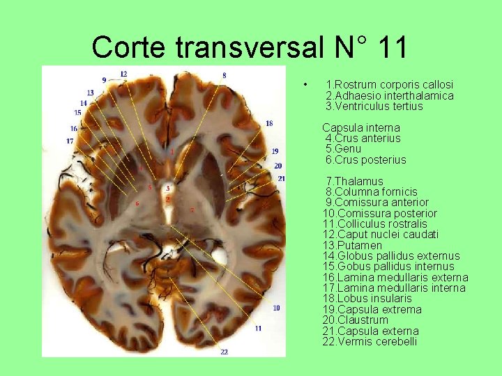 Corte transversal N° 11 • 1. Rostrum corporis callosi 2. Adhaesio interthalamica 3. Ventriculus