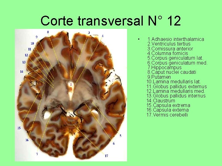 Corte transversal N° 12 • 1. Adhaesio interthalamica 2. Ventriculus tertius 3. Comissura anterior
