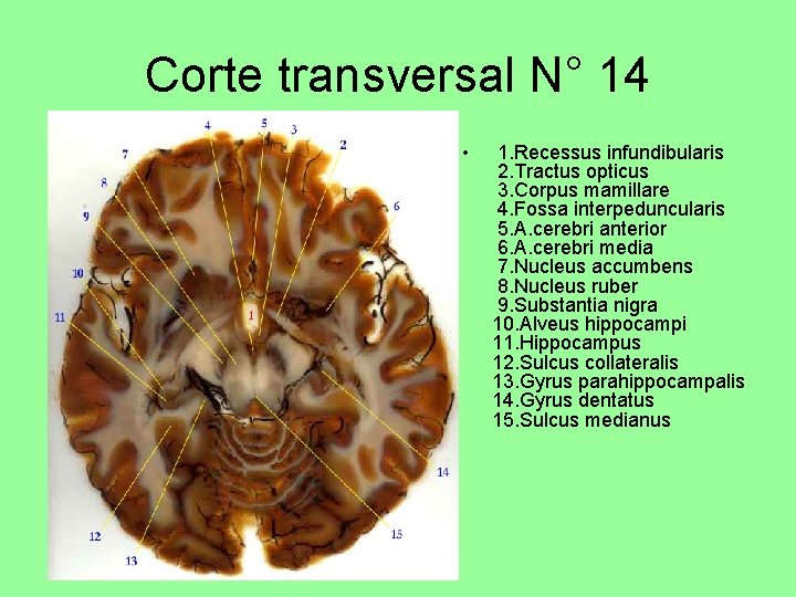 Corte transversal N° 14 • 1. Recessus infundibularis 2. Tractus opticus 3. Corpus mamillare