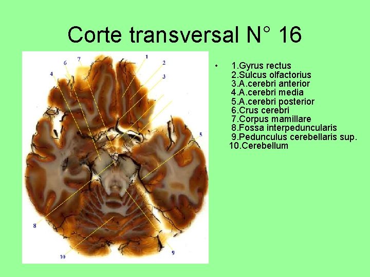 Corte transversal N° 16 • 1. Gyrus rectus 2. Sulcus olfactorius 3. A. cerebri
