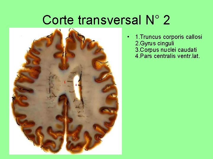 Corte transversal N° 2 • 1. Truncus corporis callosi 2. Gyrus cinguli 3. Corpus