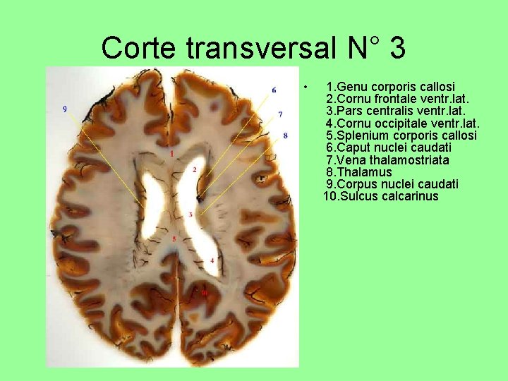 Corte transversal N° 3 • 1. Genu corporis callosi 2. Cornu frontale ventr. lat.