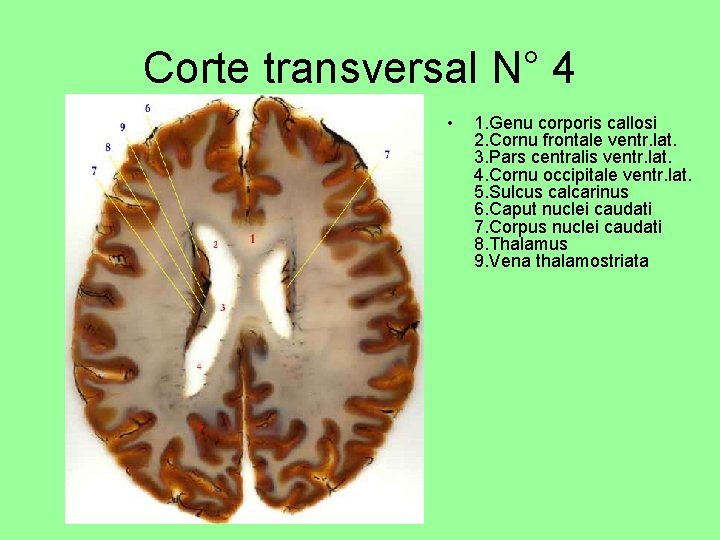 Corte transversal N° 4 • 1. Genu corporis callosi 2. Cornu frontale ventr. lat.