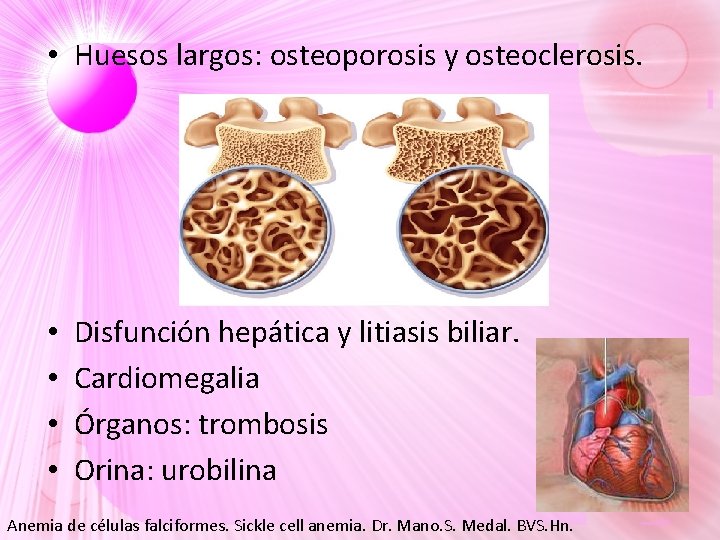 • Huesos largos: osteoporosis y osteoclerosis. • • Disfunción hepática y litiasis biliar. • Huesos largos: osteoporosis y osteoclerosis. • • Disfunción hepática y litiasis biliar.