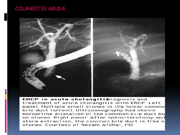 COLANGITIS AGUDA 