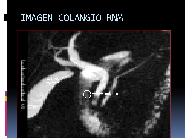 IMAGEN COLANGIO RNM Cístico En H. D. cálculo 