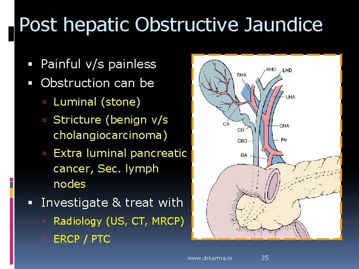 Post hepatic Obstructive Jaundice Painful v/s painless Obstruction can be Luminal (stone) Stricture (benign Post hepatic Obstructive Jaundice Painful v/s painless Obstruction can be Luminal (stone) Stricture (benign