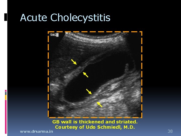 Acute Cholecystitis GB wall is thickened and striated. Courtesy of Udo Schmiedl, M. D. Acute Cholecystitis GB wall is thickened and striated. Courtesy of Udo Schmiedl, M. D.