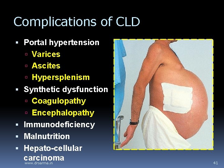 Complications of CLD Portal hypertension Varices Ascites Hypersplenism Synthetic dysfunction Coagulopathy Encephalopathy Immunodeficiency Malnutrition Complications of CLD Portal hypertension Varices Ascites Hypersplenism Synthetic dysfunction Coagulopathy Encephalopathy Immunodeficiency Malnutrition