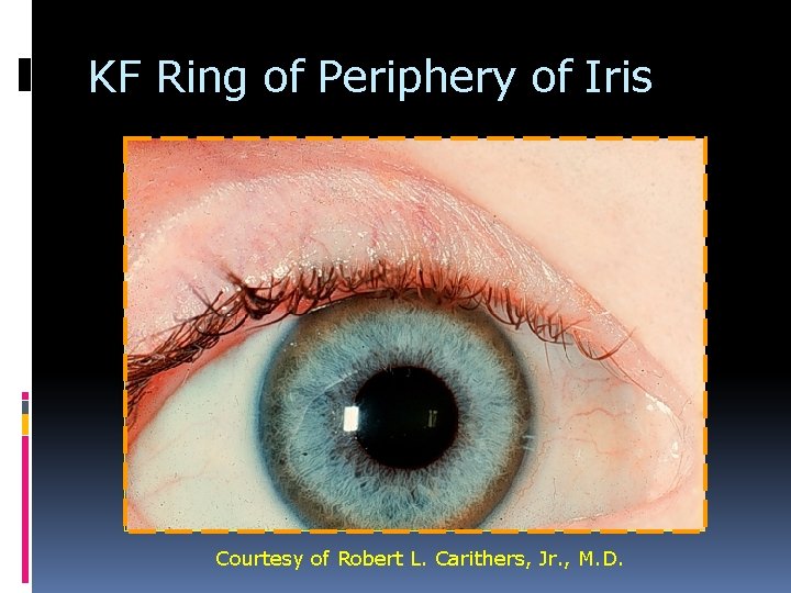 KF Ring of Periphery of Iris Courtesy of Robert L. Carithers, Jr. , M. KF Ring of Periphery of Iris Courtesy of Robert L. Carithers, Jr. , M.