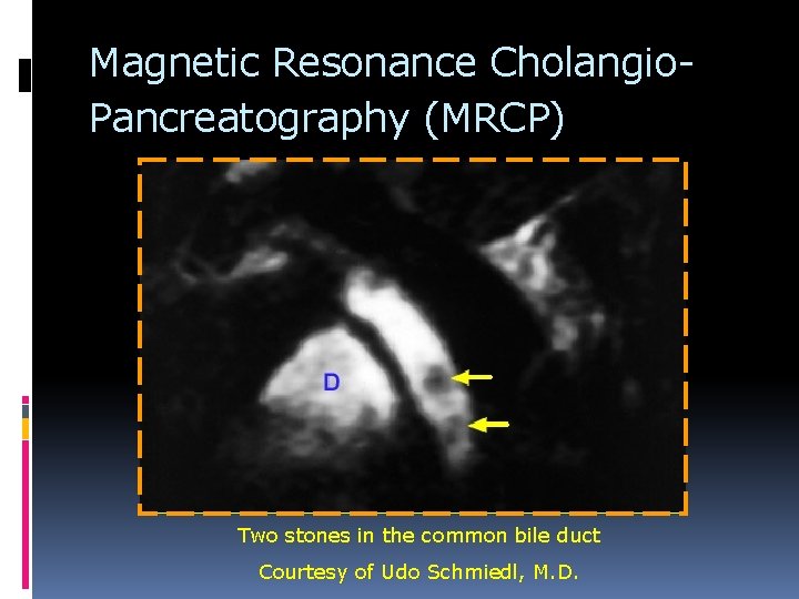 Magnetic Resonance Cholangio. Pancreatography (MRCP) Two stones in the common bile duct Courtesy of Magnetic Resonance Cholangio. Pancreatography (MRCP) Two stones in the common bile duct Courtesy of