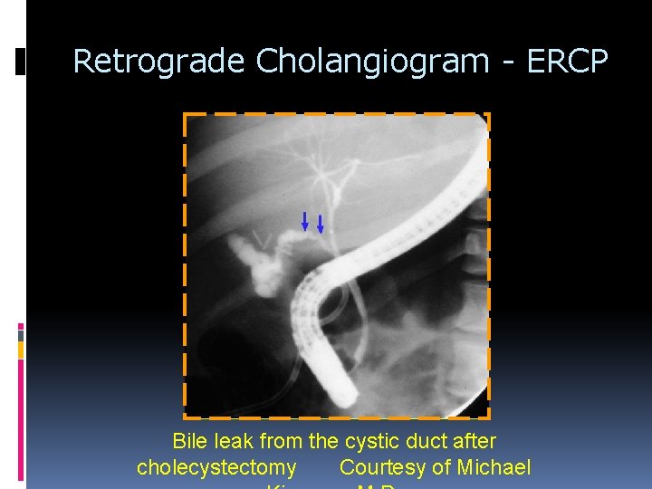 Retrograde Cholangiogram - ERCP Bile leak from the cystic duct after cholecystectomy Courtesy of Retrograde Cholangiogram - ERCP Bile leak from the cystic duct after cholecystectomy Courtesy of