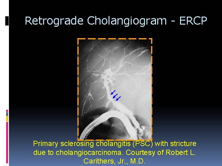 Retrograde Cholangiogram - ERCP Primary sclerosing cholangitis (PSC) with stricture due to cholangiocarcinoma. Courtesy Retrograde Cholangiogram - ERCP Primary sclerosing cholangitis (PSC) with stricture due to cholangiocarcinoma. Courtesy