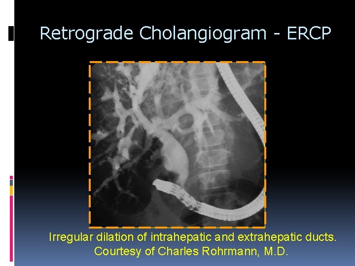 Retrograde Cholangiogram - ERCP Irregular dilation of intrahepatic and extrahepatic ducts. Courtesy of Charles Retrograde Cholangiogram - ERCP Irregular dilation of intrahepatic and extrahepatic ducts. Courtesy of Charles