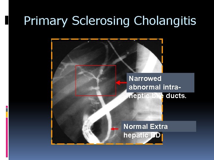 Primary Sclerosing Cholangitis Narrowed abnormal intraheptic bile ducts. Normal Extra hepatic BD Primary Sclerosing Cholangitis Narrowed abnormal intraheptic bile ducts. Normal Extra hepatic BD