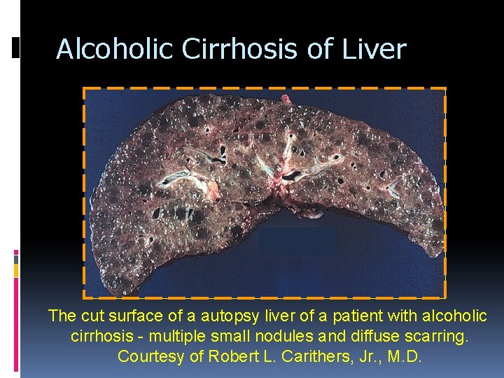 Alcoholic Cirrhosis of Liver The cut surface of a autopsy liver of a patient Alcoholic Cirrhosis of Liver The cut surface of a autopsy liver of a patient