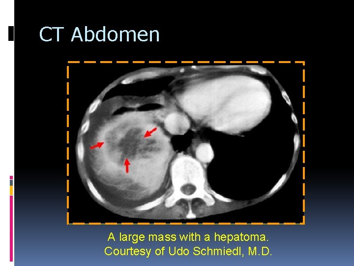 CT Abdomen A large mass with a hepatoma. Courtesy of Udo Schmiedl, M. D. CT Abdomen A large mass with a hepatoma. Courtesy of Udo Schmiedl, M. D.
