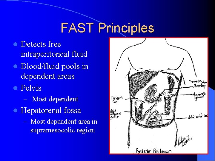 FAST Principles Detects free intraperitoneal fluid l Blood/fluid pools in dependent areas l Pelvis