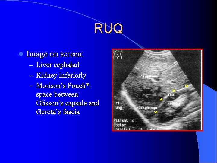 RUQ l Image on screen: – Liver cephalad – Kidney inferiorly – Morison’s Pouch*: