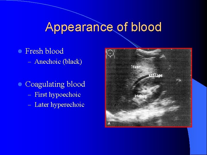 Appearance of blood l Fresh blood – Anechoic (black) l Coagulating blood – First