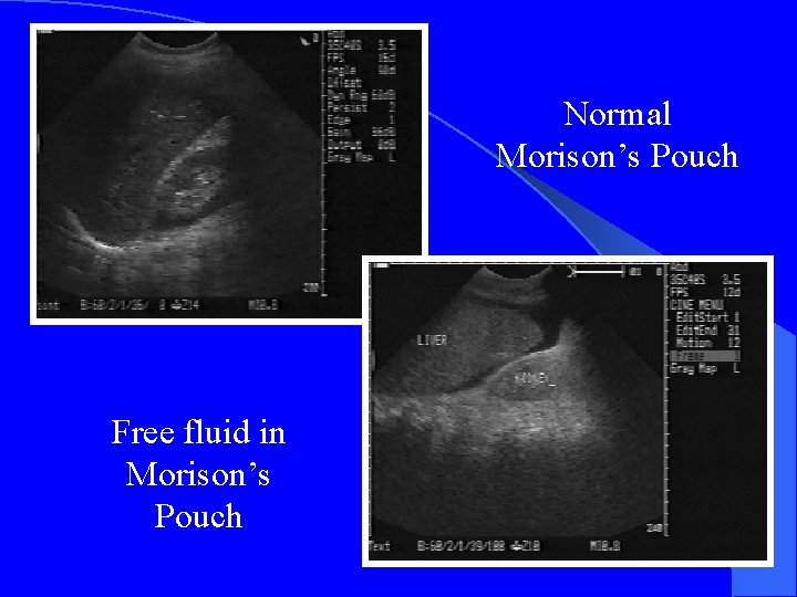 Normal Morison’s Pouch Free fluid in Morison’s Pouch 