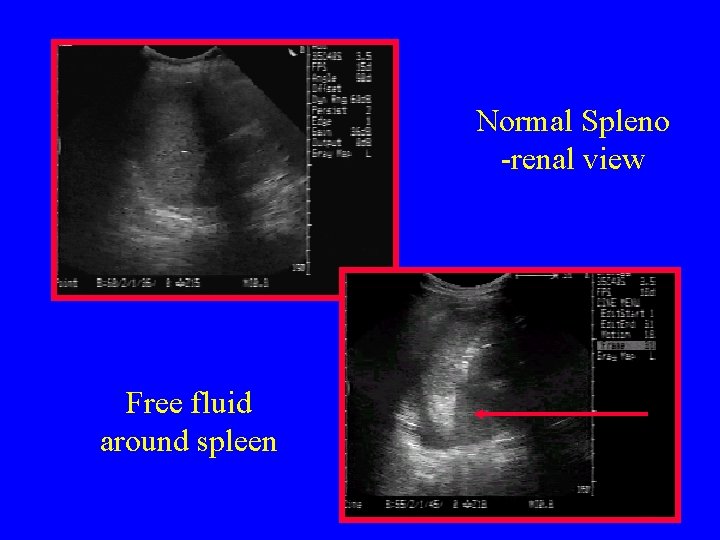 Normal Spleno -renal view Free fluid around spleen 