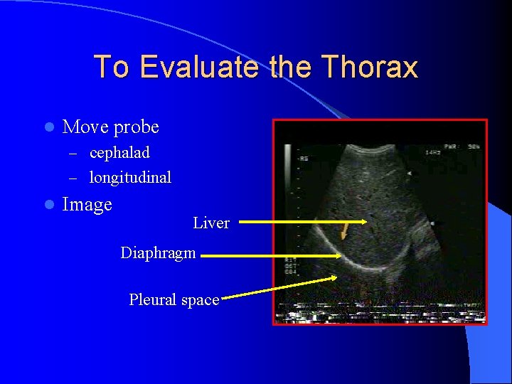 To Evaluate the Thorax l Move probe – cephalad – longitudinal l Image Liver
