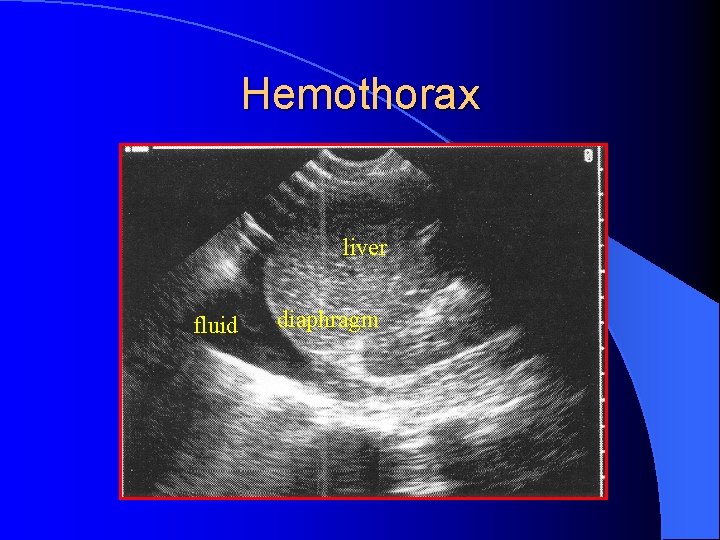 Hemothorax liver fluid diaphragm 