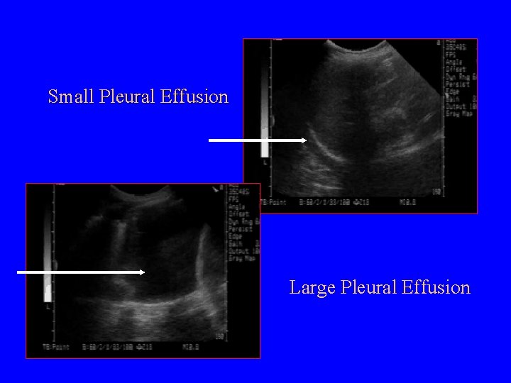 Small Pleural Effusion Large Pleural Effusion 