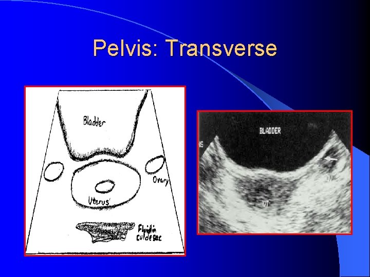 Pelvis: Transverse 