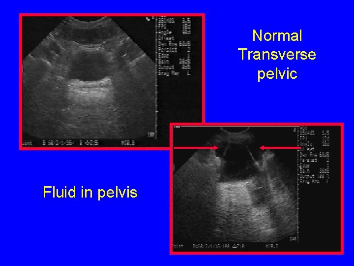 Normal Transverse pelvic Fluid in pelvis 