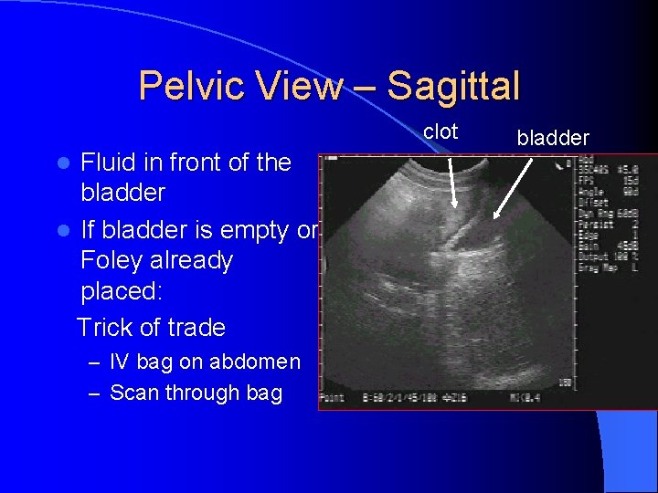 Pelvic View – Sagittal clot Fluid in front of the bladder l If bladder