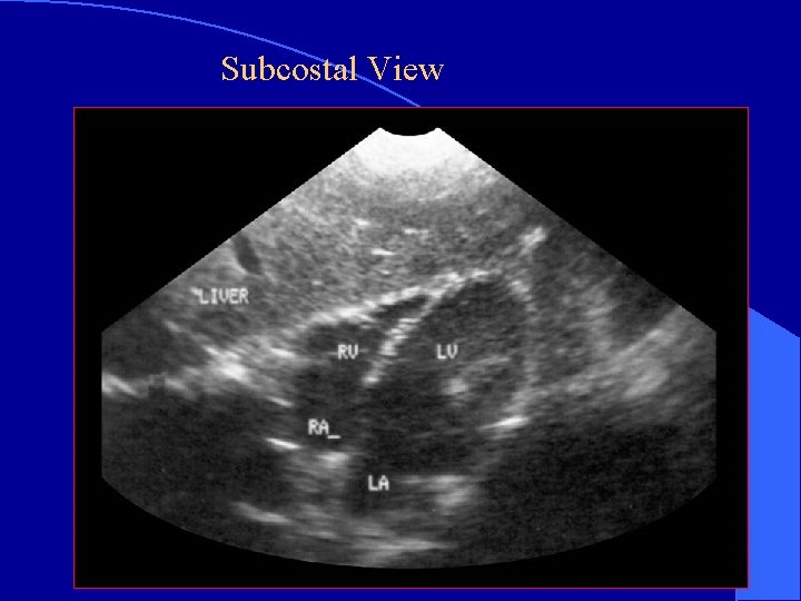 Subcostal View 