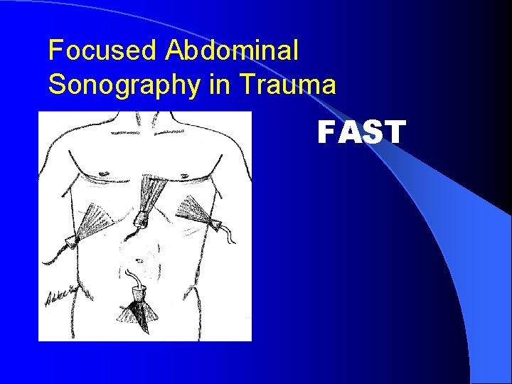 Focused Abdominal Sonography in Trauma FAST 