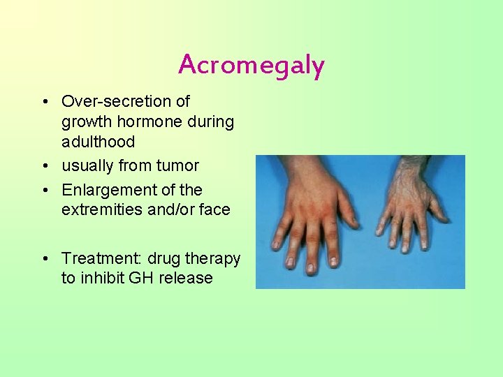 Acromegaly • Over-secretion of growth hormone during adulthood • usually from tumor • Enlargement