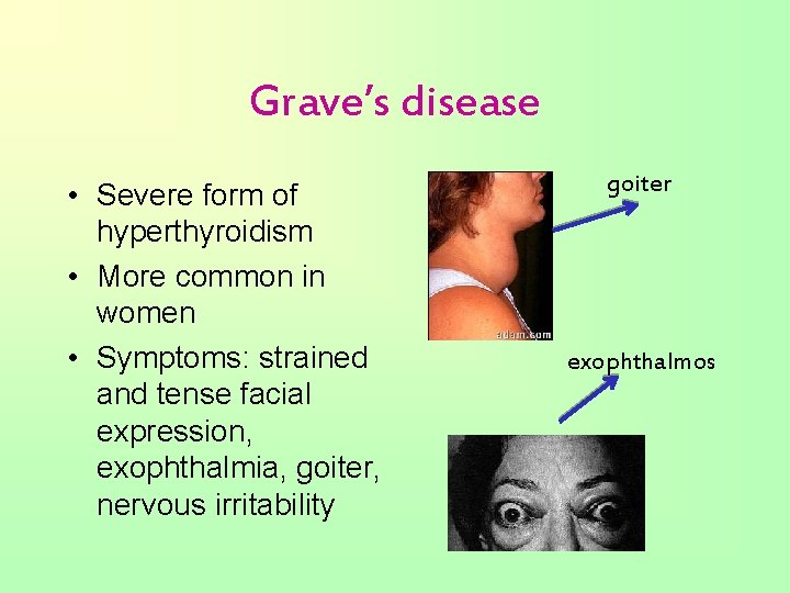Grave’s disease • Severe form of hyperthyroidism • More common in women • Symptoms: