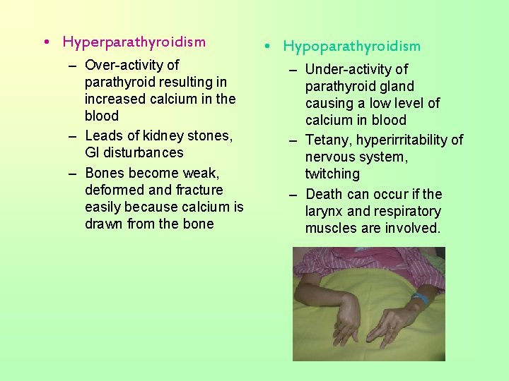  • Hyperparathyroidism – Over-activity of parathyroid resulting in increased calcium in the blood