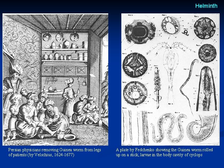 Helminth Persian physicians removing Guinea worm from legs of patients (by Velschius, 1624 -1677) Helminth Persian physicians removing Guinea worm from legs of patients (by Velschius, 1624 -1677)